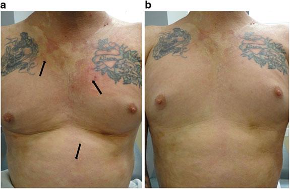 produced remission and lesion softening. Note that residual hyperpigmentation remains Fig. 2.
