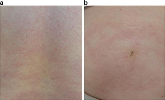 Although treatment halted progression and produced skin softening, loss of subcutaneous tissue persists Fig. 2.