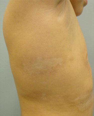 2 Localized Scleroderma 9 Fig. 2.4 Hyper- and hypopigmentation on the abdomen in a patient with circumscribed morphea.