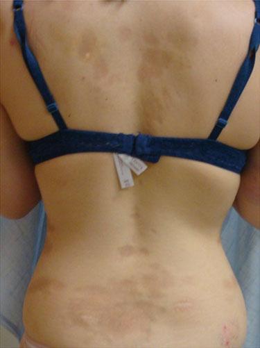 This is in contrast to subcutaneous atrophy in which the normal body contour is altered.