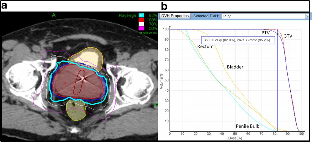 Janowski et al. Radiation Oncology 2014, 9:241 Page 3 of 10 Figure 1 Treatment Planning and Delivery. (a) The volumes represent the GTV (red), PTV (blue), rectum (light green), and bladder (yellow).