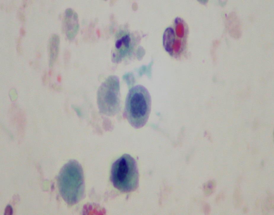 Non-Invasive Papillary Urothelial Carcinoma, High-Grade, Infiltrating Urothelial Carcinoma and Urothelial Carcinoma In Situ. (Fig.4.15).