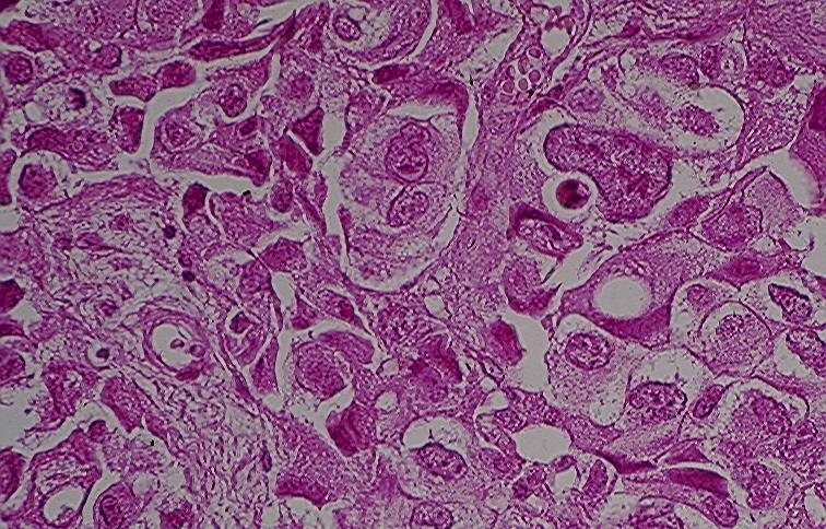 B: Histology of a high-grade infiltrating urothelial carcinoma. (HE).