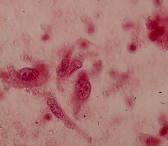 C: Four large malignant epithelial cells with hypochromatic nuclei with irregular nuclear contours and prominent nucleoli.