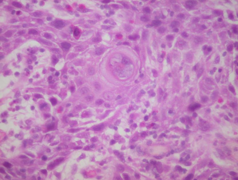 Fig.4.18. Bladder sarcomatoid urothelial carcinoma: A: Tumor consisting of spindle cells with prominent nucleoli. (HE).