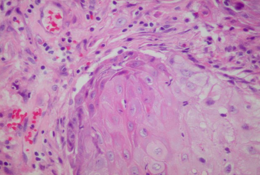 Fig.4.19. Bladder well-differentiated squamous cell carcinoma: A. Histology of the tumor. (HE). B. Keratinizing squamous cells with hyperchromatic, angulated or oval nuclei in voided urine. (Pap).