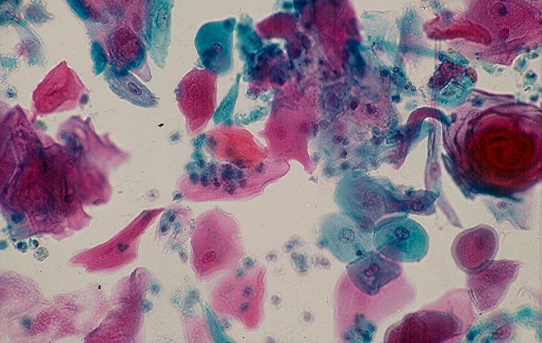 It is rare in non-endemic areas. Verrucous carcinoma in patients with long-stading anogenital condyloma acuminata and bladder condyloma acumunatum may be related to HPV infection.