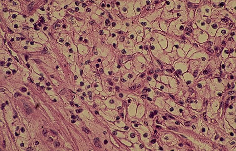 component of a conventional renal cell carcinoma. The tumor shows in urine spindle malignant cells that are present predominantly singly.