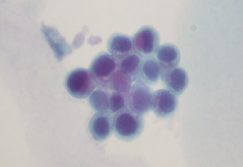 4- Infection, lithiasis, radiation and chemotherapy may also cause some cellular alterations (nuclear enlargement and hyperchromasia, conspicuous nucleoli) mimicking cells of a low-grade urothelial