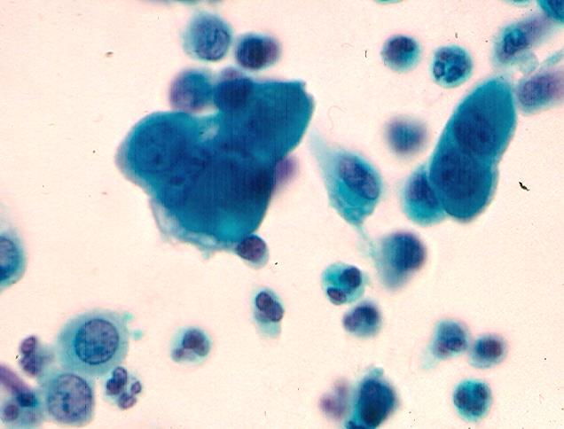 D Fig.1.1. Benign mesothelial cell proliferation. (Pap): A. Hyperplastic mesothelial cells with slightly enlarged nuclei, micronucleoli are present singly and in small clusters.