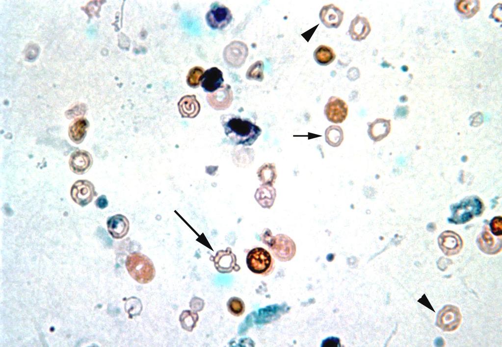 Cytologic findings In Nguyen s 2003 study of 178 patients with histologically confirmed renal glomerular diseases 4 smear patterns were identified, and each pattern was associated with different
