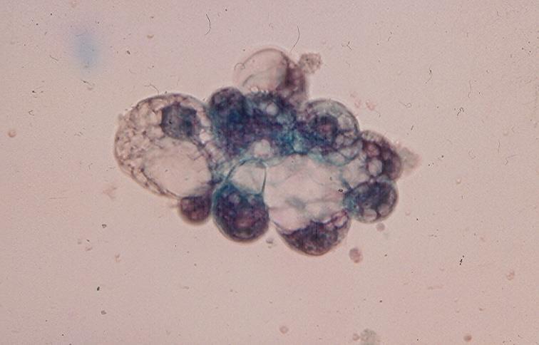 A B Fig.5.5. A patient with focal glomerular sclerosis with nephrotic syndrome showing in urine: A. A cluster of renal tubular cells with intracytoplasmic fat droplets. (Pap). B. A tubular fatty cast, a tubular epithelial cell and a few polymorphonuclear leukocytes.