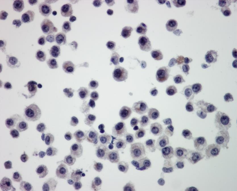 patients with multiple myeloma. Exogenous nephrotoxins include antibiotics, radiographic contrast material and cyclosporine.