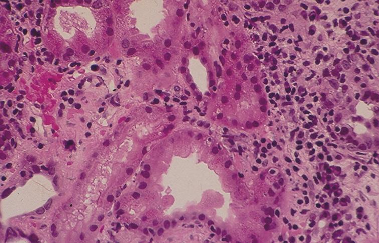 Acute glomerulonephritis and Acute interstitial nephritis. The urine cytologic findings in these two conditions have been previously discussed.