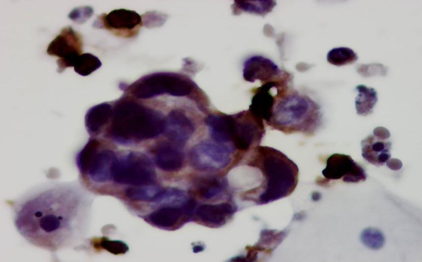 B C Fig. 5.12. A to C: Clustered pleomorphic RRTCs with prominent nucleoli showing a positive cytoplasmic staining reaction to vimentin antibody.
