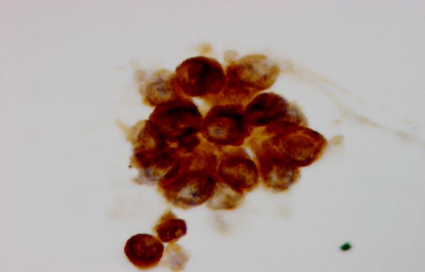 Clusters of renal tubular cells with yellow bile-stained cytoplasm may be found urine of patients with severe jaundice and hepatorenal syndrome. (Fig.5.14).