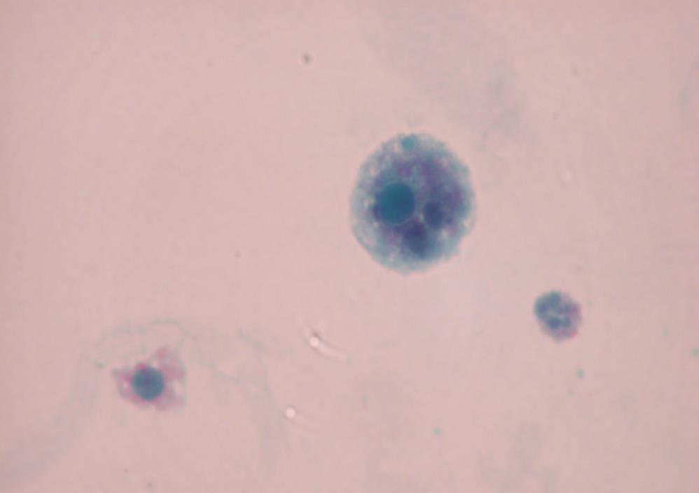 Fig. 5.15. A degenerated macrophage with intracytoplasmic Michealis-Gutmann body and one degenerated renal tubular cell in urine sediment of a patient with renal malakoplakia. (Pap).