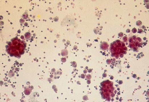 An adenomatoid mesothelioma may exfoliate cells