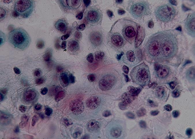 ball-like clusters (A), papillary