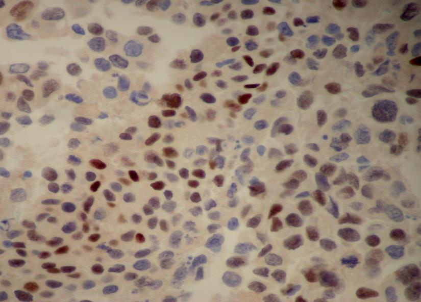 C Fig.1.10. ICC of effusion CB in EM. (ABC): A. Tumor cells show strong cytoplasmic reaction to calretinin antibody. B.