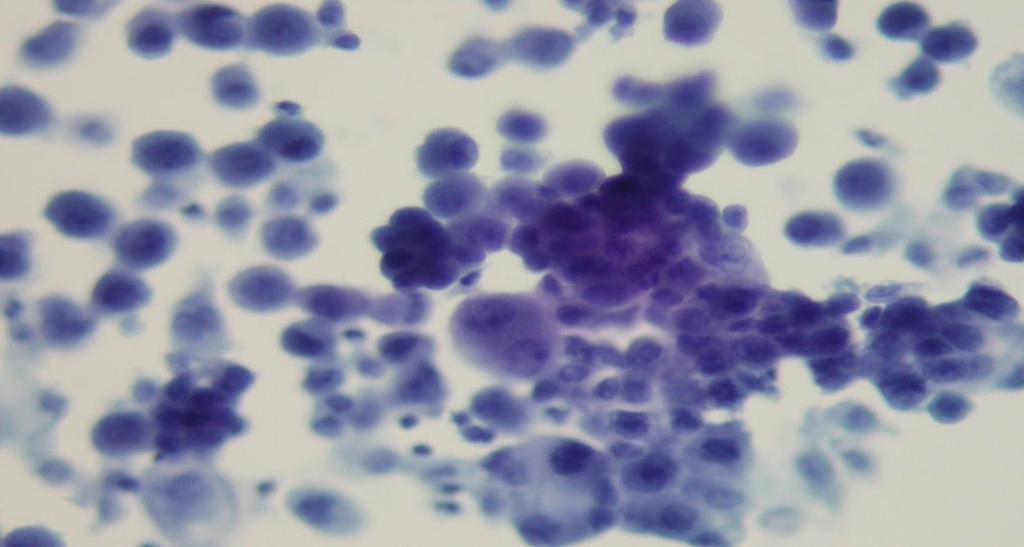 Carcinomas arising from certain anatomic sites may have some specific cytologic manifestations in serous effusions.