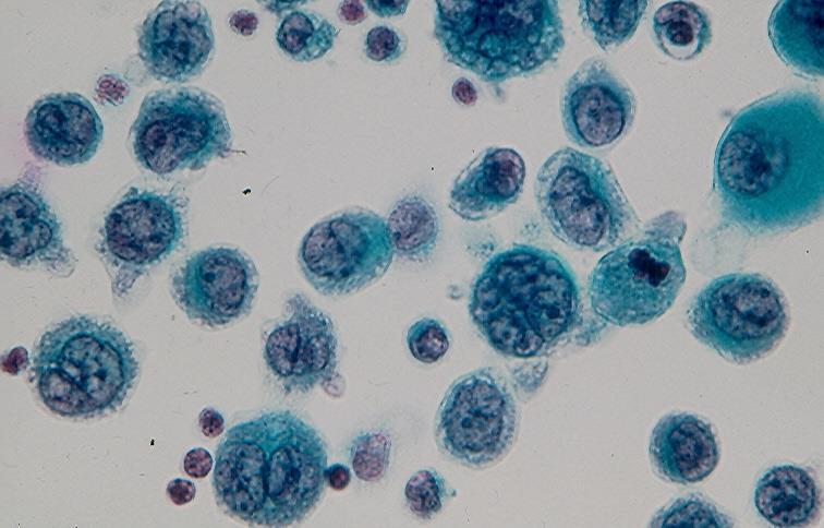 (Uranyl acetate and lead citrate stain, x 18,000). 2. Large cell carcinoma yields single, large pleomorphic cells.