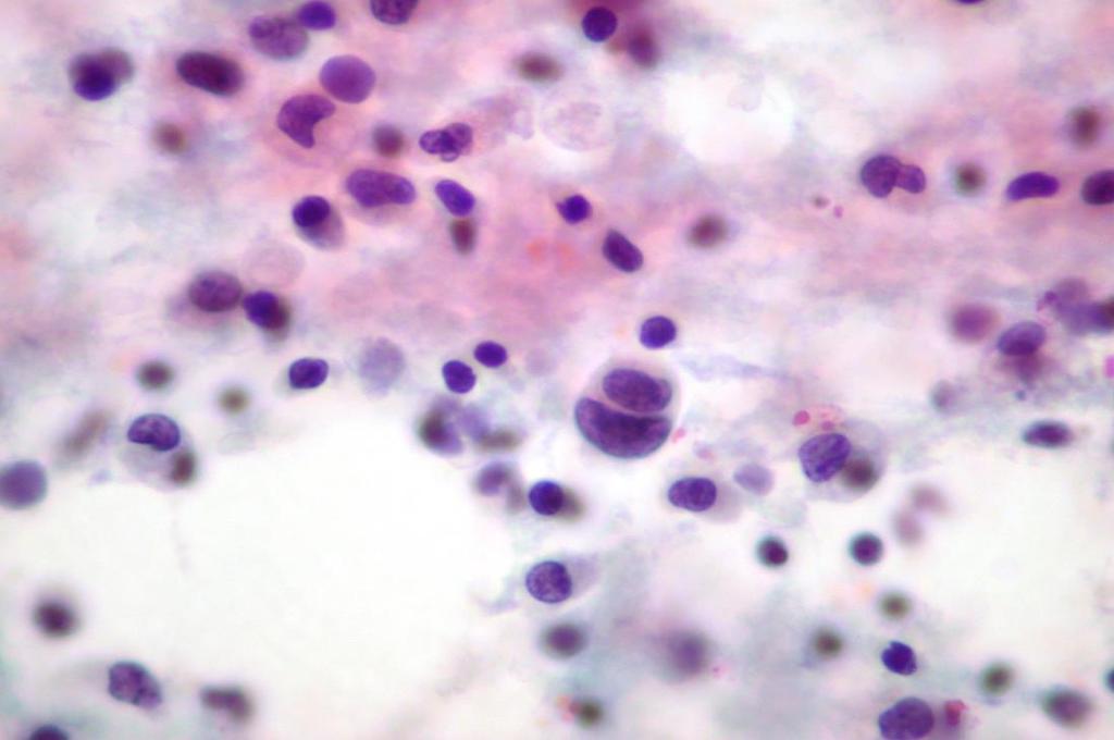 irregular syncytial clusters of non-keratinizing cells. (Pap). Fig.1.19.