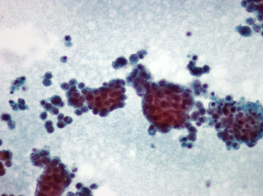 In some cases the tumor cells are present singly. (Fig.1.24).