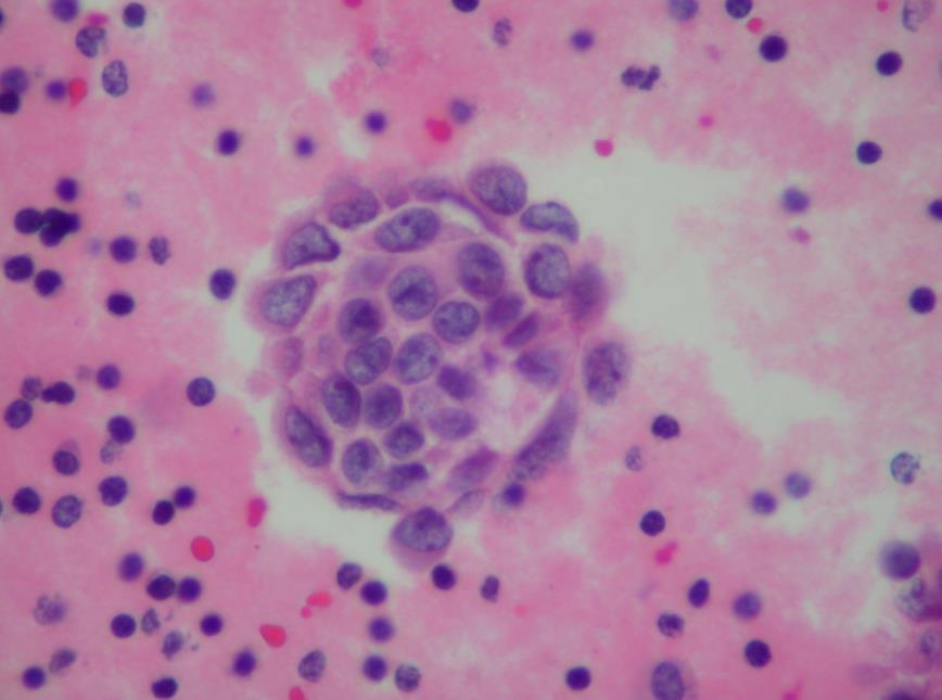 showing in A tumor cells with prominent nucleoli in a tight