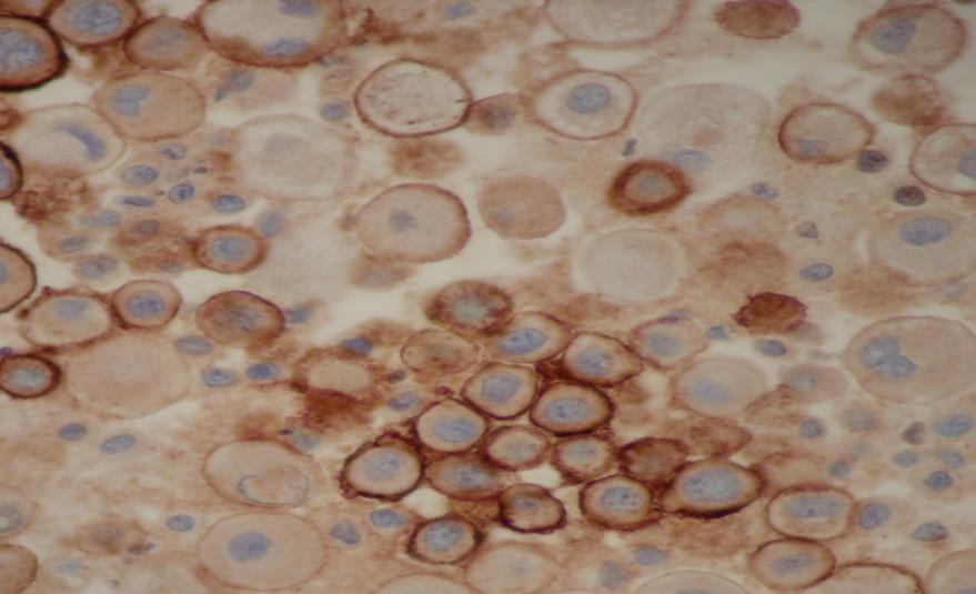 carcinoma showing predominantly single cells.