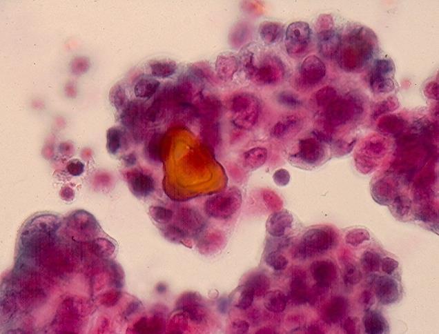of tumor cells containing a laminated psammoma body.