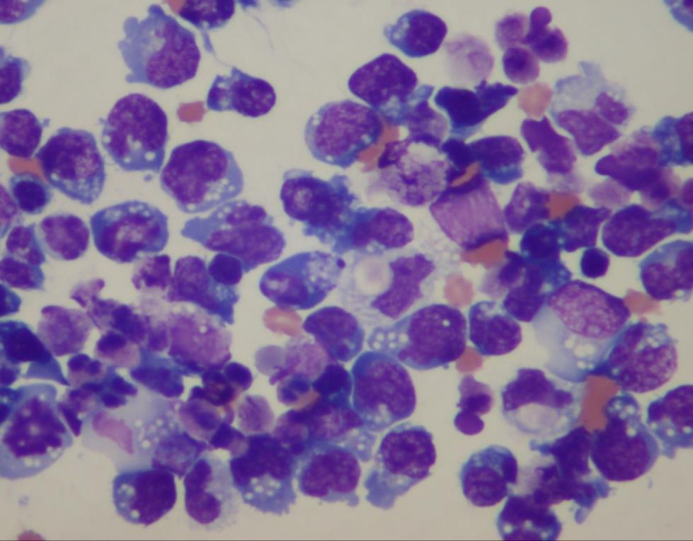 High-grade tumor showing large cells with pleomorphic nuclei and