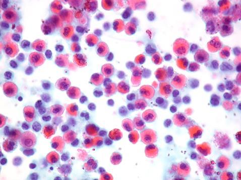 Fig.1. 44. Eosinophil-rich effusion. (Pap) 3.