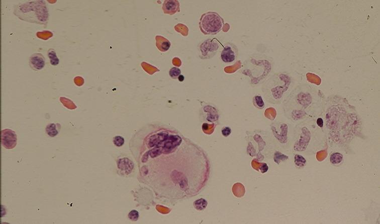 B Fig.1.45. Benign bone marrow cells including a multinucleate megakaryocyte in ascitis of a woman developing extramedullary hematopoiesis secondary to myelofibrosis with anemia. (Pap, A and B) 4.