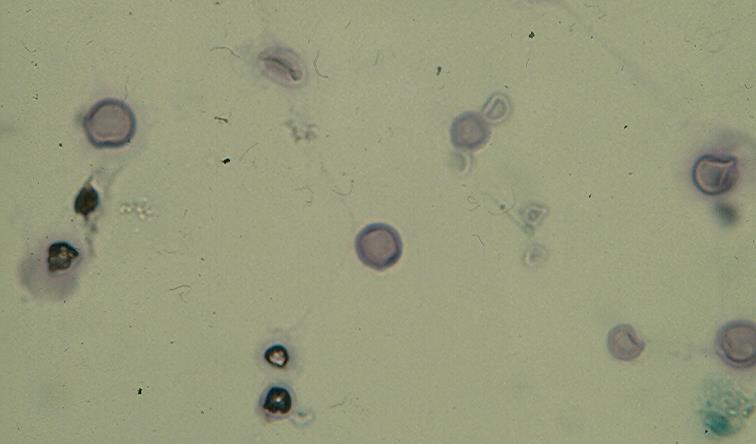 Fig.3.1. Cryptococcal meningitis showing in CSF thick-walled yeasts with budding. (Pap). Neoplasms Of the tumors involving the CSF, metastatic cancers are more common than primary tumors.
