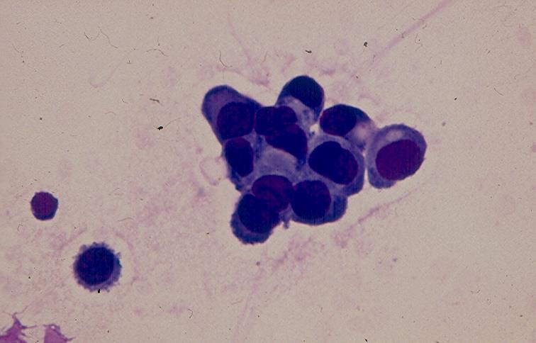 Fig.3.4. Choroid plexus carcinoma showing in CSF single and clustered malignant epithelial cells. (MGG).