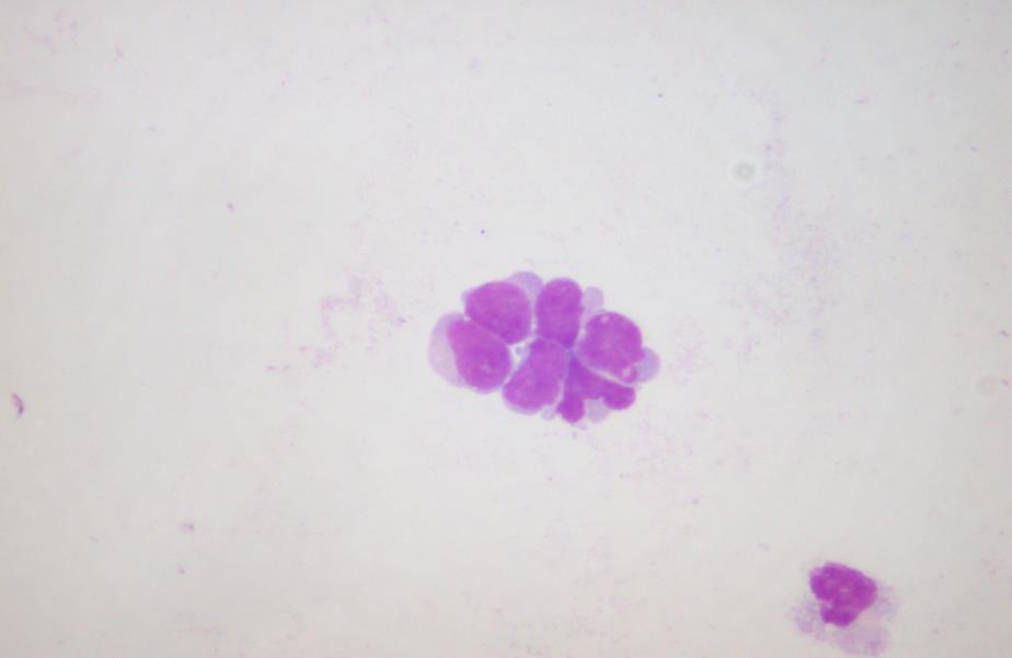 Fig.3.6. A cluster of metastatic small cell carcinoma cells in CSF showing nuclear molding.