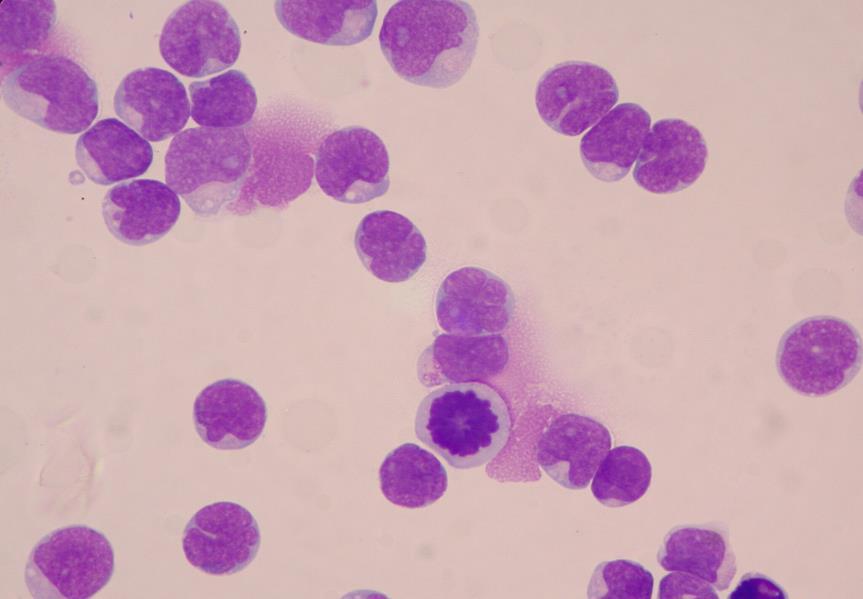 Fig.3.10. Numerous monomorphic lymphoblasts with nuclear clefts and prominent nucleoli are present in CSF of a patient with acute lymphoblastic leukemia. (Wright stain). (Courtesy of Dr. J.