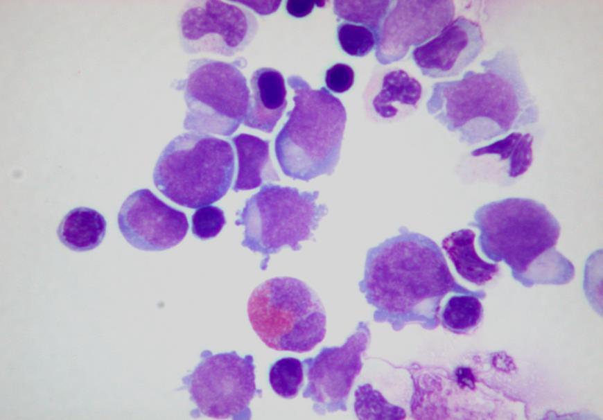 Cells derived from an acute myeloid leukemia cells are, in general, large and show round or highly irregular nuclei, fine chromatin and prominent nucleoli.