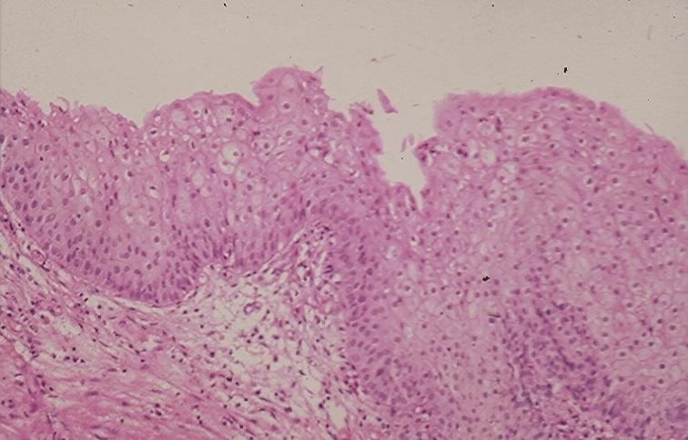 In premenopausal women the trigone squamous epithelium may show cyclic changes. (Fig. 4.1). A B Fig. 4. 1. A. Histology of normal urothelium. (HE) B.