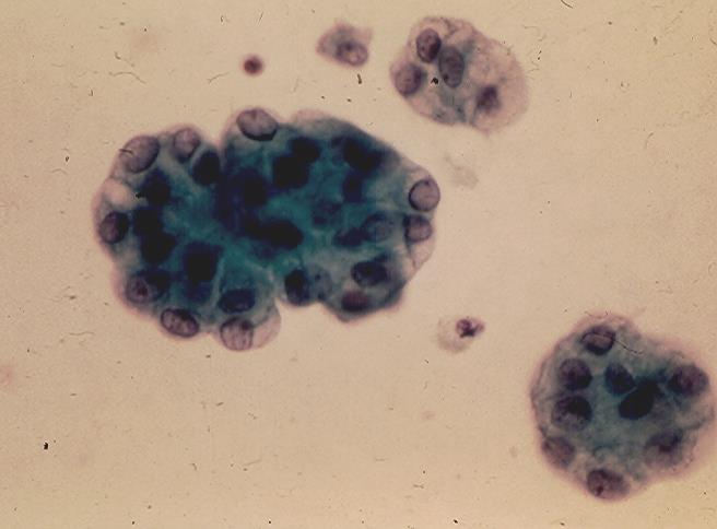 Benign columnar urothelial cells present singly, in row or loose cluster. (Pap).