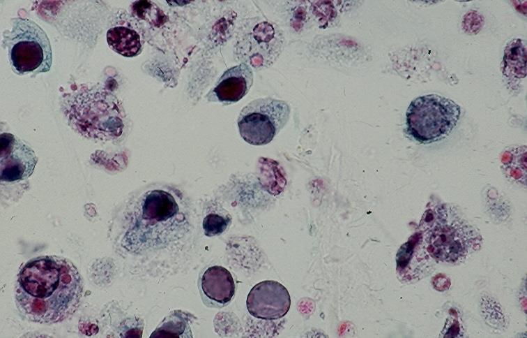 - Herpes simplex virus infection shows giant multinucleate cells with molded, homogenous, ground-glass nuclei.