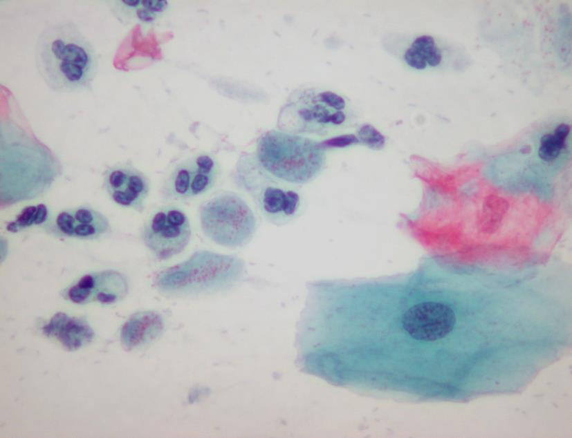 Fig.4.7. Trichomonas vaginalis organisms with intracytoplasmic eosinophilic granules. (Pap). 4. Malakoplakia is a rare chronic granulomatous inflammation of the urinary tract.