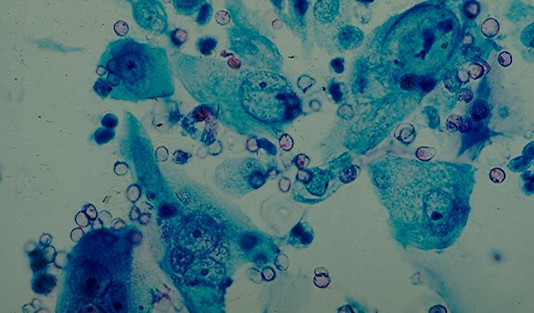urothelial cells. (Fig.4.9). In a study of voided urine samples in patients with urinary lithiasis, Highmann and Wilson have found that in over 52.6% of cases no cytologic changes were noted. In 40.