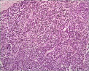 3 Rosen, peter paul: carcinoma with metaplasia in rosens breast pathology Third edition, Philadelphia: Lippincott Williams & Wilkins: 2009; 470-474. 4 D. Rayson, A. A. Adjei, V. J. Suman, L. E.