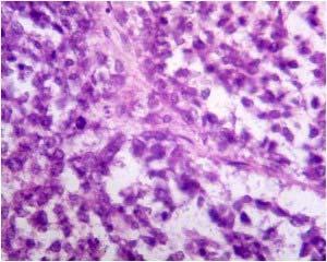 Figure 3: photomicrograph of tumor with