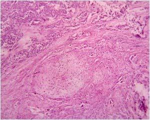 tumor shows carcinomatous area with
