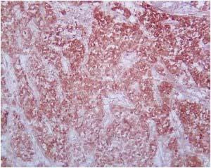6: photomicrograph of tumor with