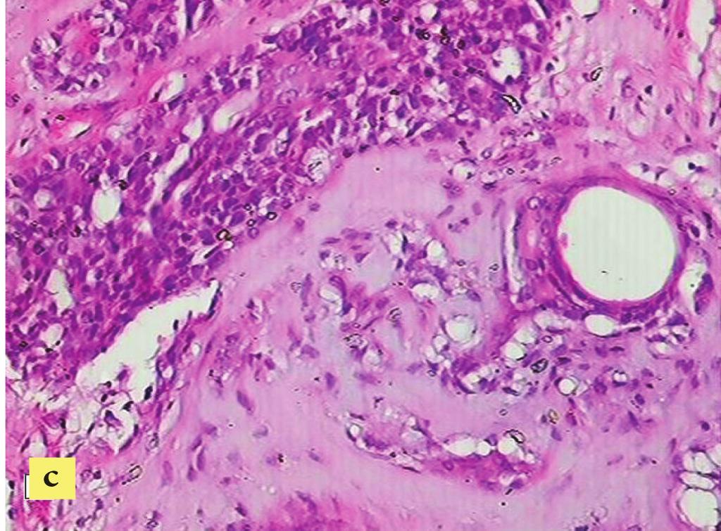 Discussion Pleomorphic Adenoma of Breast (PAB) is an uncommon neoplasm, accounting for 68 cases in the literature (1).