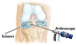 Procedure The orthopaedic surgeon will make a few small incisions in your knee. A sterile solution will be used to fill the knee joint and rinse away any cloudy fluid.